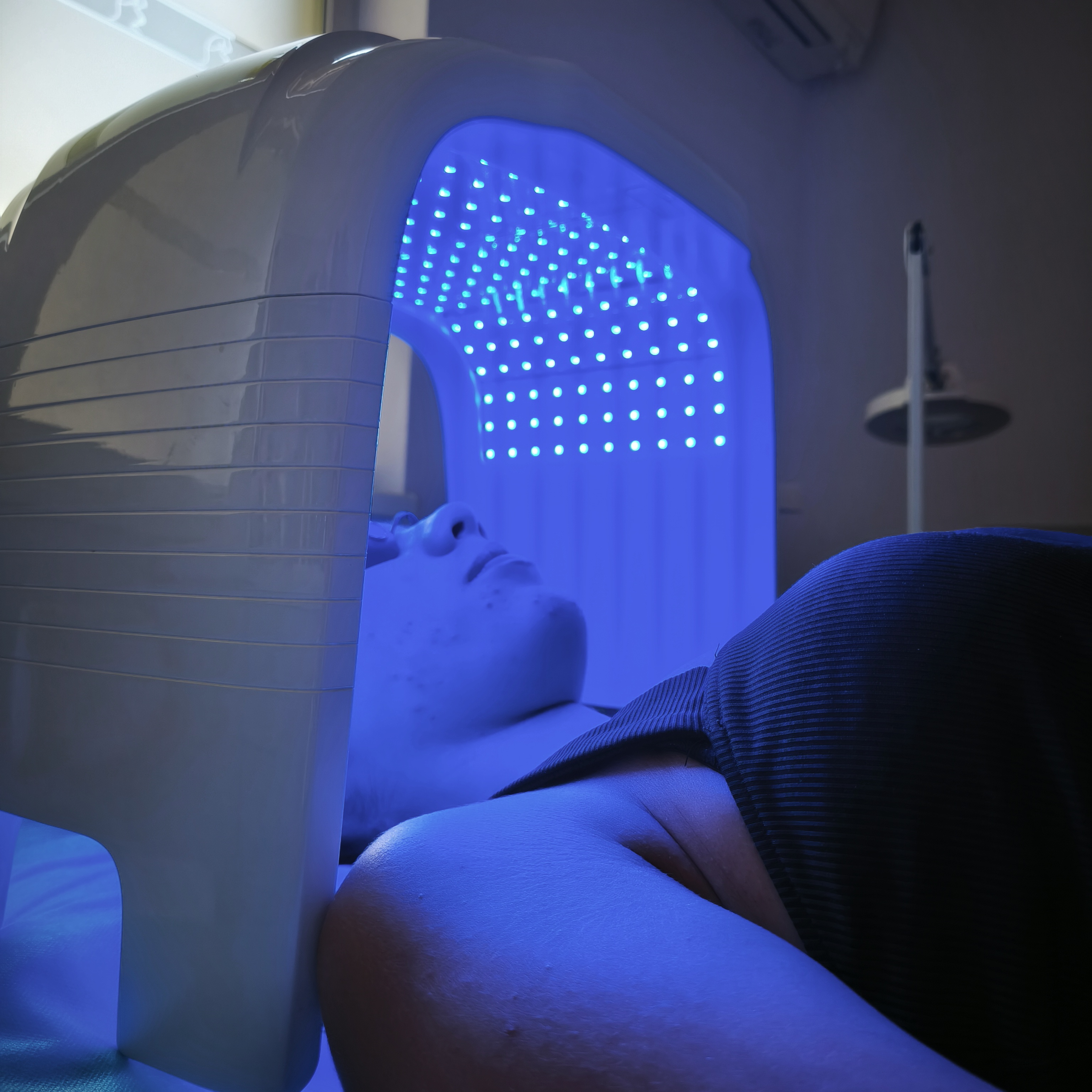 Лечение на акне