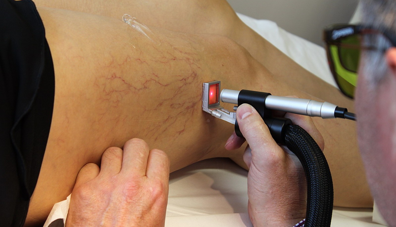 Премахване на капиляри с лазер